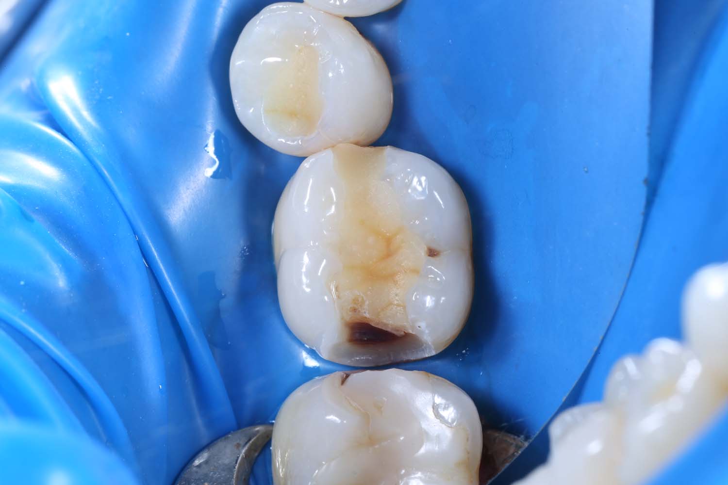 Лечение кариеса зубов до и после
