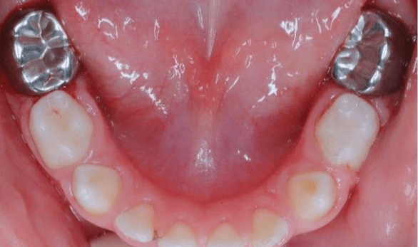 Лечение кариеса жевательных зубов у детей - фото после