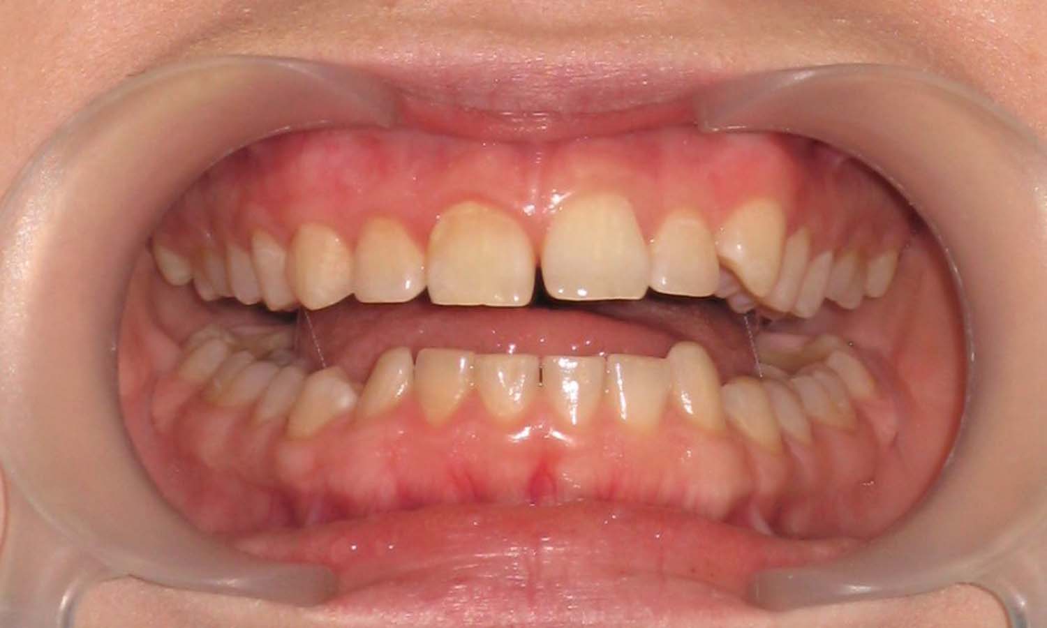 Ортодонтическое лечение - фото до