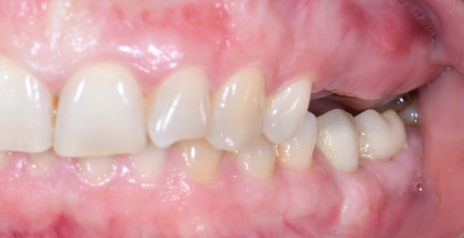 Протезирование на имплантах жевательной группы зубов - фото до