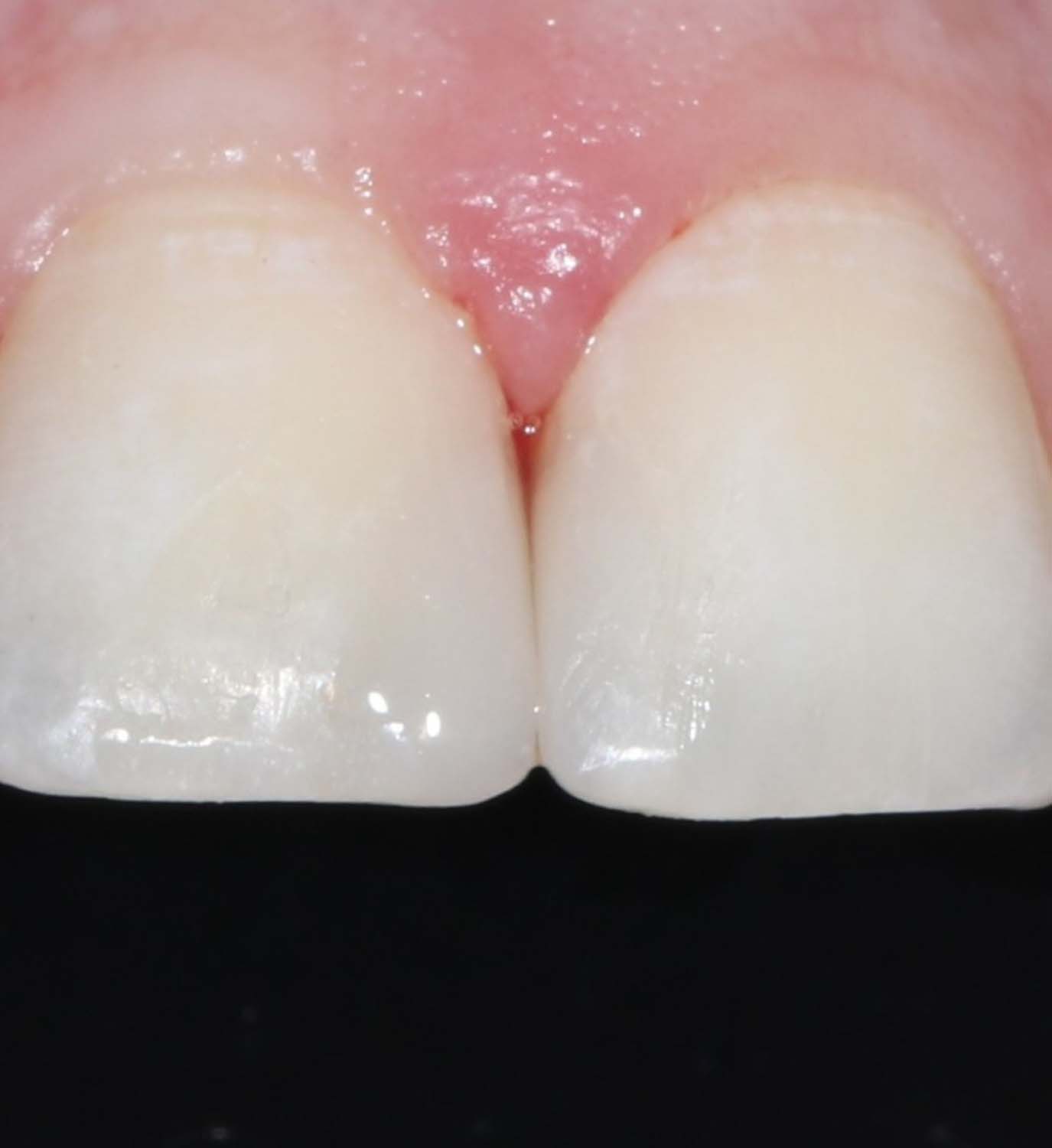 Реставрация фронтальных зубов - фото после