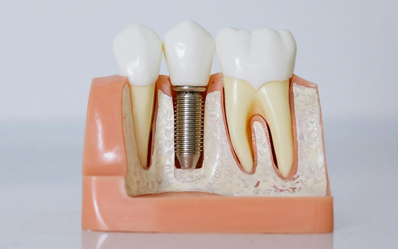 Имплант зуба