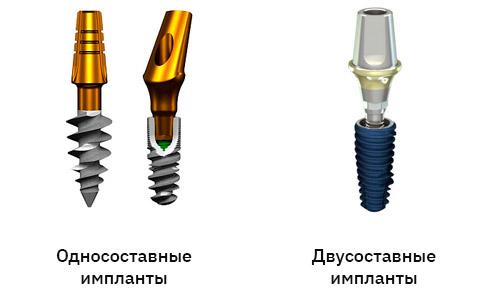 Разновидности имплантатов зубов